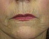 Ridding Lip Lines & Wrinkles with C02 Laser