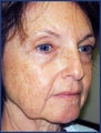CO2 laser skin resurfacing