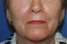 Peri-Oral Co2 Laser