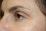 CO2 Laser resurfacing