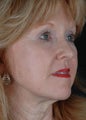 CO2 Laser Resurfacing 