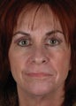 CO2 Laser Resurfacing 