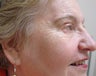 DIFF ANGLES - CO2 laser resurfacing with blepharoplasty