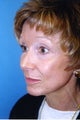 Before and After Co2 Laser Skin Resurfacing with Dr. Clevens
