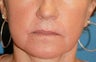 Co2 Laser Skin Resurfacing