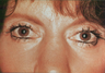 Fractional CO2 Resurfacing and upper bleph