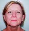 SmartXide CO2 Laser Resurfacing (DOT Therapy)