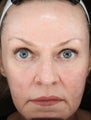 CORE Fractional CO2 Resurfacing