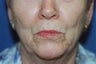 Peri-Oral Co2 Laser