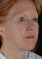 CO2 Laser Resurfacing 
