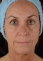 CO2 Laser Resurfacing 