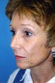 Before and After Co2 Laser Skin Resurfacing with Dr. Clevens