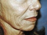 Co2 Laser Skin Resurfacing