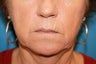 Co2 Laser Skin Resurfacing