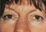 Fractional CO2 Resurfacing and upper bleph