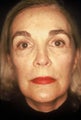 CO2 Laser Resurfacing