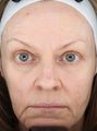 CORE Fractional CO2 Resurfacing