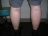 Calf Implants