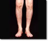 Calf Implant