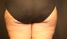 Cellulite Treatment