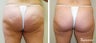 Velashape, after 5 treatments