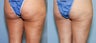 38 year old with cellulite