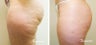 Velashape, after 5 treatments