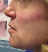 Radiesse Cheeks, below corners of mouth and marrionettes