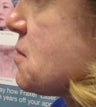 Radiesse Cheeks, below corners of mouth and marrionettes