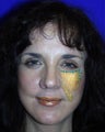 Cheek lift diagram superimposed on actual patient
