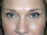 Cheek Lift