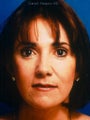  Cheeklift (Minifacelift), Lateral Temporal Browlift, Bilateral Lower Blepahroplasty. 