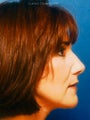  Cheeklift (Minifacelift), Lateral Temporal Browlift, Bilateral Lower Blepahroplasty. 