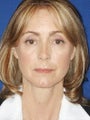 Cheeklift (Minifacelift), Bilateral Upper Blepharoplasty, Periorbital TCA Chemical Peel, Soft Tissue Filler to Nasolabial Folds 
