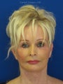 Cheeklift (minifacelift) with TCA chemical peel to the lower eyelids performed in the office under oral sedation with local anes