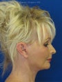 Cheeklift (minifacelift) with TCA chemical peel to the lower eyelids performed in the office under oral sedation with local anes
