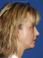 Cheeklift (Minifacelift) with TCA chemical peel to the lower eyelids, performed comfortably in the office.