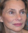 Midfacial Rejuvenation