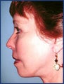 Mid facelift, lower facelift and upper blepharoplasty