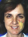 Cheek lift diagram superimposed on actual patient
