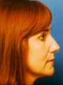  Cheeklift (Minifacelift), Lateral Temporal Browlift, Bilateral Lower Blepahroplasty. 
