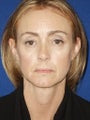 Cheeklift (Minifacelift), Bilateral Upper Blepharoplasty, Periorbital TCA Chemical Peel, Soft Tissue Filler to Nasolabial Folds 