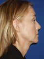  Cheeklift (Minifacelift), Bilateral Upper Blepharoplasty, Periorbital TCA Chemical Peel, Soft Tissue Filler to Nasolabial Folds