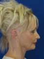 Cheeklift (minifacelift) with TCA chemical peel to the lower eyelids performed in the office under oral sedation with local anes