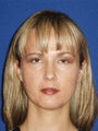 Cheeklift (Minifacelift) with TCA chemical peel to the lower eyelids, performed comfortably in the office.