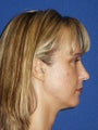 Cheeklift (Minifacelift) with TCA chemical peel to the lower eyelids, performed comfortably in the office.