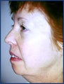Mid facelift, lower facelift and upper blepharoplasty