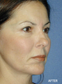 Cheek Implant Surgery