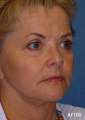 Facelift, Eyelid and Cheek Implant Surgery