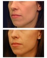 Cheek Augmentation